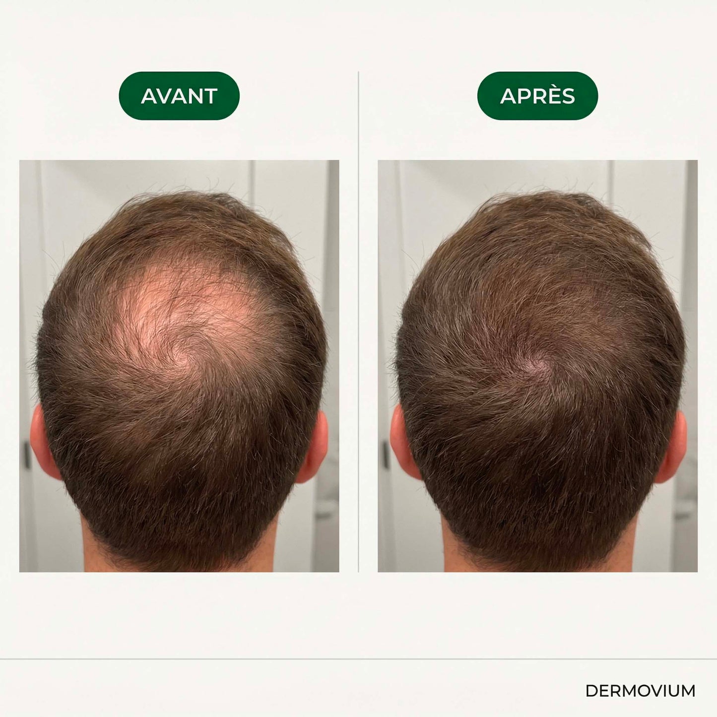 Technologie Capillaire | Micro-infuse® Homme